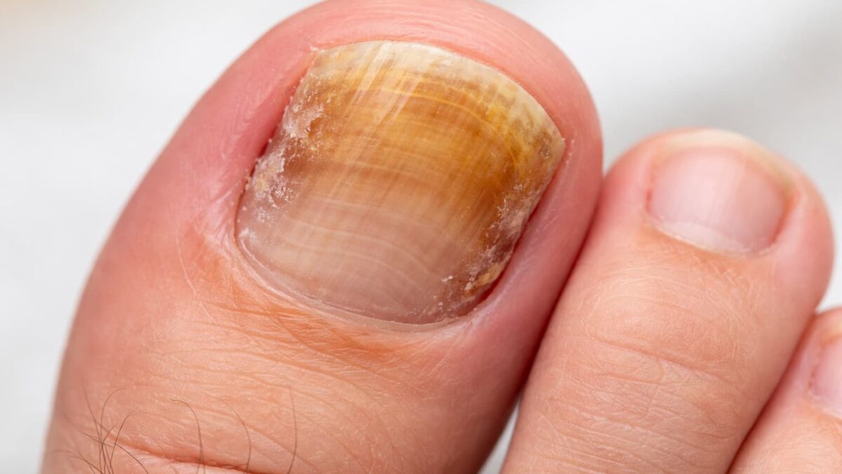 Ονυχομυκητίαση σε νύχι ποδιού με κιτρινωπή δυσχρωμία και πάχυνση