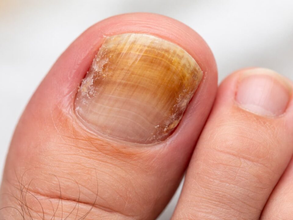 Ονυχομυκητίαση σε νύχι ποδιού με κιτρινωπή δυσχρωμία και πάχυνση
