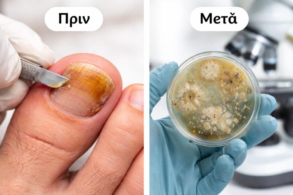 Λήψη δείγματος νυχιού για διάγνωση ονυχομυκητίασης