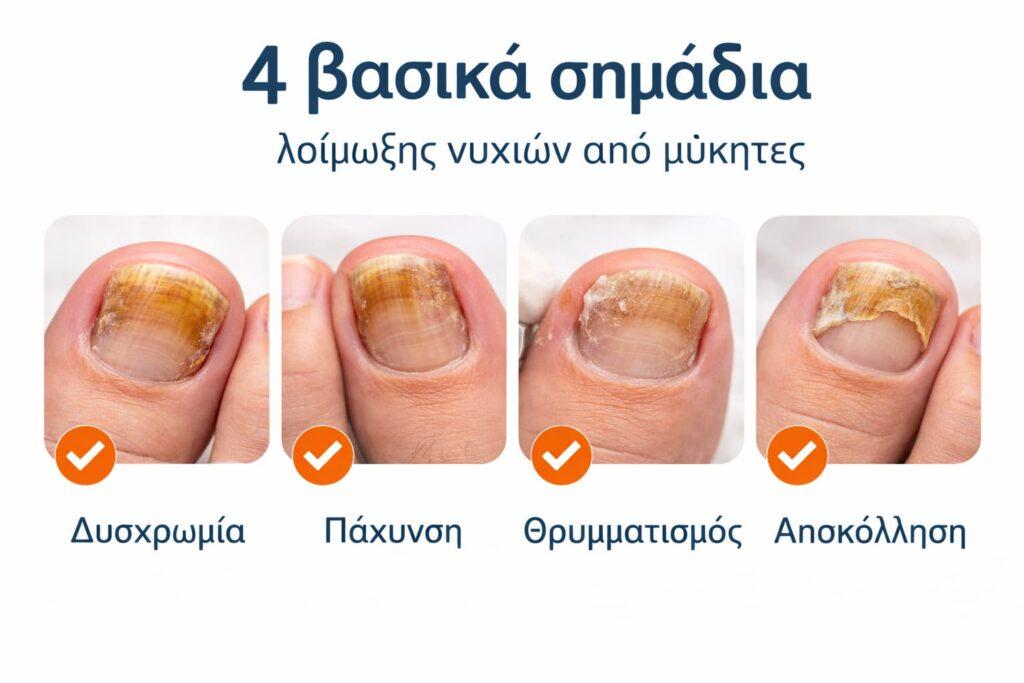 Συμπτώματα ονυχομυκητίασης: δυσχρωμία πάχυνση θρυμματισμός αποκόλληση