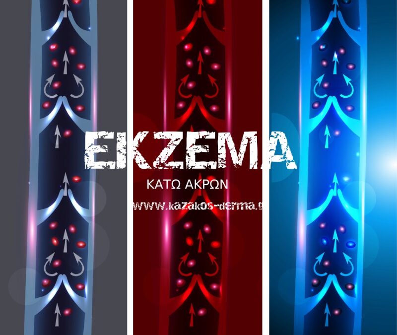 δερματίτιδα, πρήξιμο στα πόδια, έκζεμα, δέρμα, φλεβικη ανεπαρκεια, kazakos dermatologist, kazakos dermatologos, καλοσ δερματολογοσ αθηνα, καζακοσ δερματολογοσ dermalab, καζακοσ δερματολογοσ, δερματολογοσ κολωνακι, δερματολογοσ συνταγμα, Δερματολογικο κεντρο κολωνακι, οι καλυτεροι δερματολογοι στην αθηνα, καζακος χαρης, δερματολογοσ μετροπολιταν,
