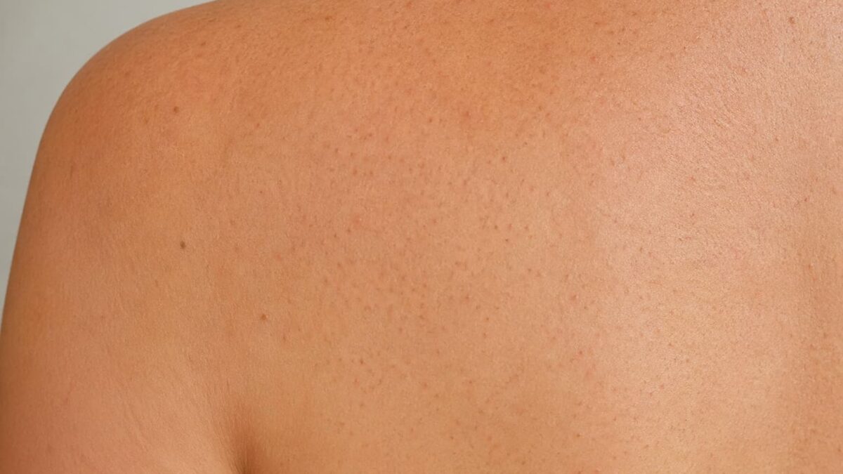 Θυλακίτιδα ή ακμή; Τ