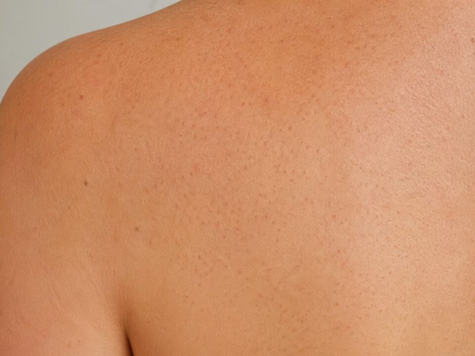 Θυλακίτιδα ή ακμή; Τ